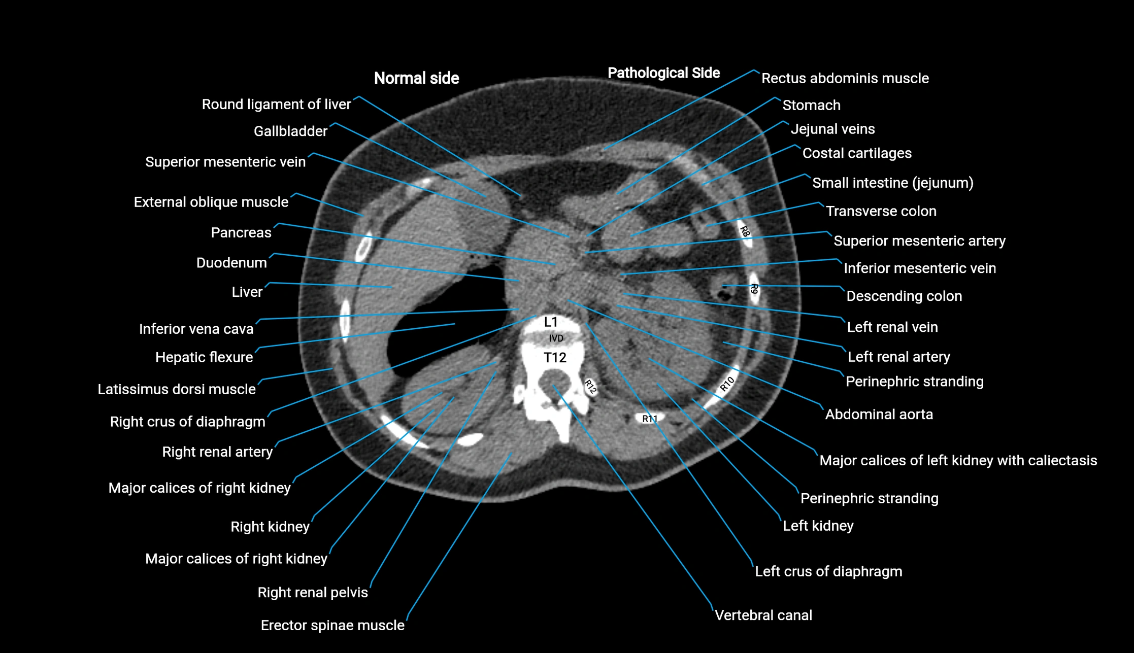 CT KUB axial cross sectional anatomy  radiology image -img-00201-00034.webp